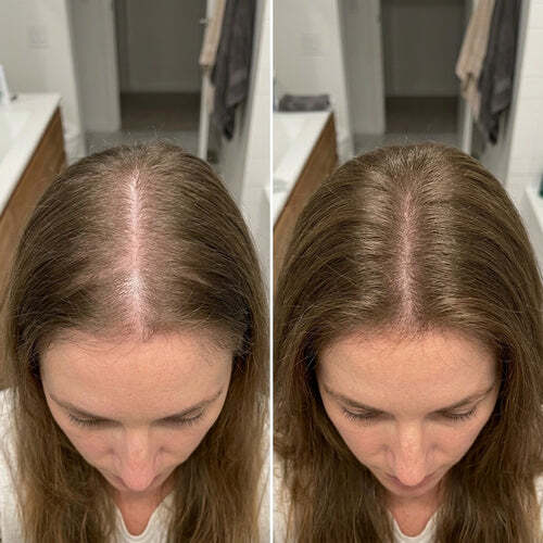 Antes y despues, densidad capilar